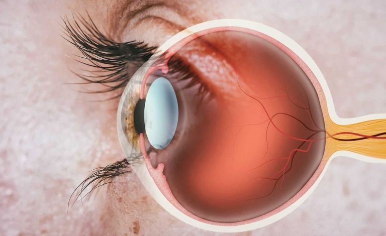 Retinopatia cukrzycowa - u chorych często widać popękane naczynka krwionośne na skutek niewielkich krwotoków na powierzchni gałki ocznej