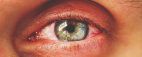 Retinopatia cukrzycowa - widoczne popękane naczynka krwionośne w oku