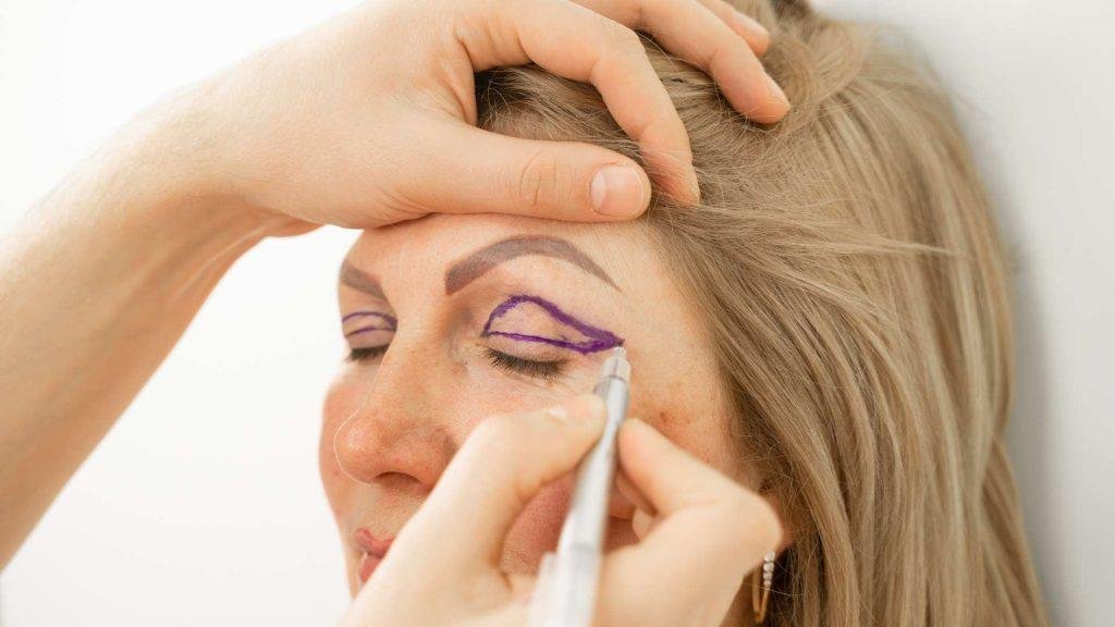 blefaroplastyka
