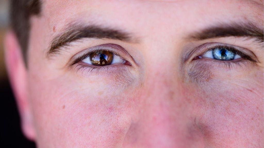 heterochromia