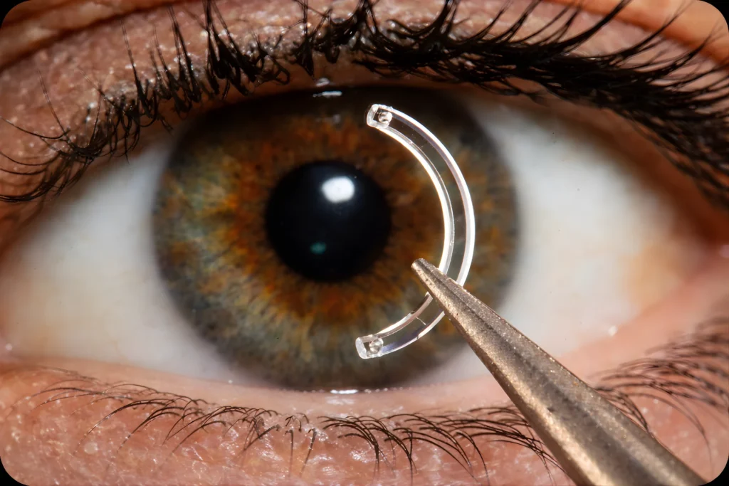 leczenie stożka rogówki