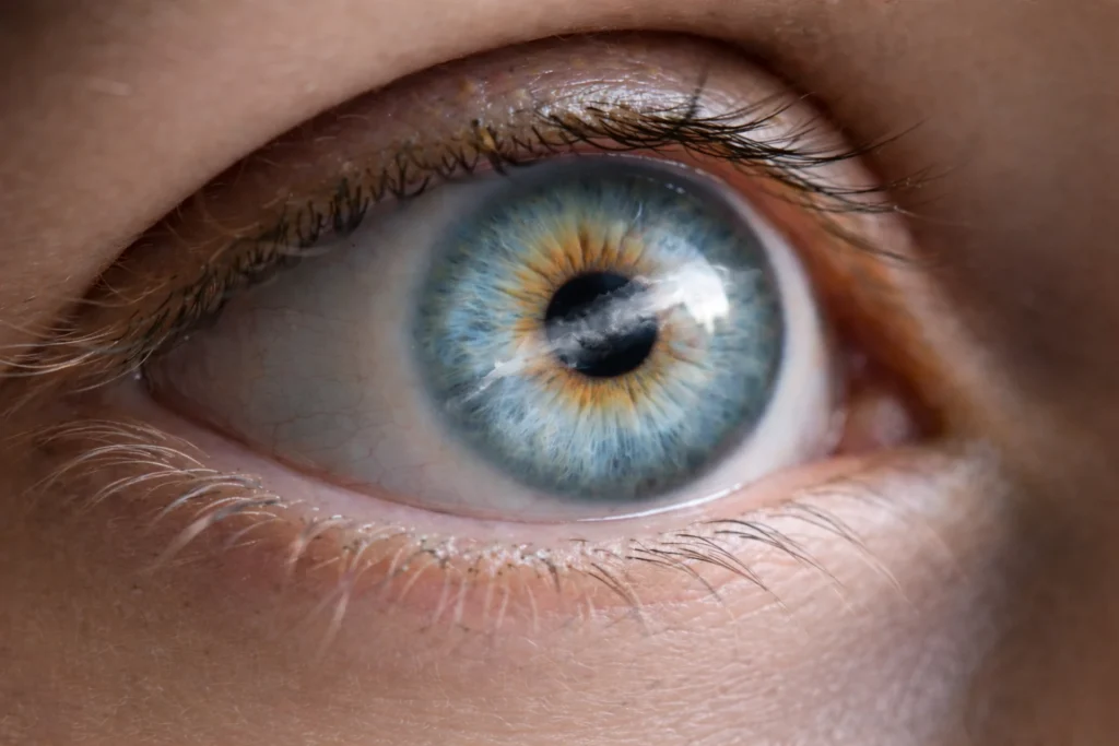 Likwidacja blizn rogówkowych